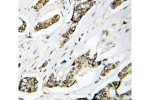 Anti-Hsp105 antibody, IHC(P) IHC(P): Human Mammary Cancer Tissue (HSPH1 抗体  (C-Term))