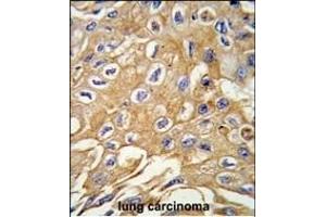 Formalin-fixed and paraffin-embedded human lung carcinoma tissue reacted with RIP3 (RIPK3) antibody (Center) (ABIN391273 and ABIN2841323) , which was peroxidase-conjugated to the secondary antibody, followed by DAB staining. (RIPK3 抗体  (AA 61-91))