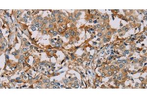 Immunohistochemistry of paraffin-embedded Human liver cancer tissue using CD204 Polyclonal Antibody at dilution of 1:30 (Macrophage Scavenger Receptor 1 抗体)