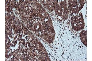 Immunohistochemical staining of paraffin-embedded Adenocarcinoma of Human ovary tissue using anti-LIMK1 mouse monoclonal antibody. (LIM Domain Kinase 1 抗体)