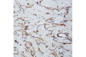 Anti-VEGF antibody, IHC(P) IHC(P): Human Lung Cancer Tissue