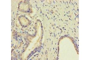 Immunohistochemistry of paraffin-embedded human prostate cancer using ABIN7173007 at dilution of 1:100 (TMPRSS11D 抗体  (AA 201-418))