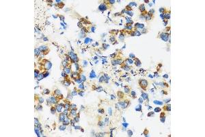 Immunohistochemistry of paraffin-embedded human lung cancer using F antibody (ABIN3016158, ABIN3016159, ABIN3016160 and ABIN6219586) at dilution of 1:100 (40x lens). (APOBEC3F 抗体  (AA 1-65))
