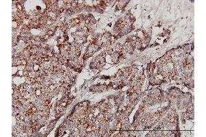 Immunoperoxidase of monoclonal antibody to GBA on formalin-fixed paraffin-embedded human breast cancer. (GBA 抗体  (AA 146-235))