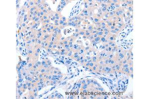 Immunohistochemistry of Human lung cancer using NUAK1 Polyclonal Antibody at dilution of 1:60 (NUAK1 抗体)