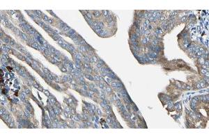 ABIN6272952 at 1/100 staining Human cervical cancer tissue by IHC-P.