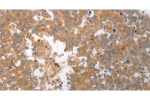 Immunohistochemistry of paraffin-embedded Human breast cancer tissue using SHH Polyclonal Antibody at dilution 1:40 (Sonic Hedgehog 抗体)