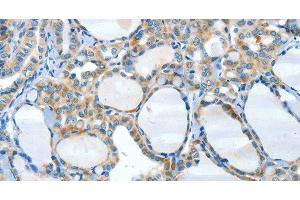 Immunohistochemistry of paraffin-embedded Human thyroid cancer tissue using HID1 Polyclonal Antibody at dilution 1:50 (HID1/DMC1 抗体)