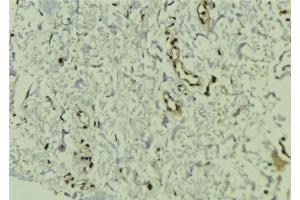 ABIN6272454 at 1/100 staining Human breast cancer tissue by IHC-P. (Cytidine Monophosphate (UMP-CMP) Kinase 1, Cytosolic (CMPK1) (N-Term) 抗体)