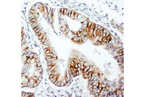 IHC-P: CCR5 antibody testing of human rectal cancer tissue (CCR5 抗体  (N-Term))
