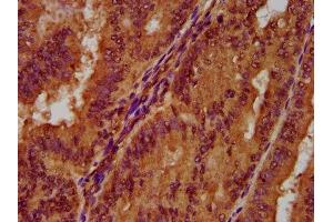 IHC image of ABIN7162774 diluted at 1:300 and staining in paraffin-embedded human endometrial cancer performed on a Leica BondTM system. (PGLYRP1 抗体  (AA 22-196))