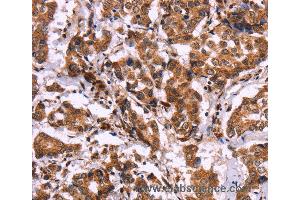 Immunohistochemistry of Human liver cancer using CARD11 Polyclonal Antibody at dilution of 1:40 (CARD11 抗体)