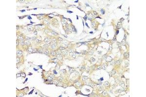 Immunohistochemistry of paraffin-embedded Human breast cancer using EIF3B Polyclonal Antibody at dilution of 1:100 (40x lens). (EIF3B 抗体)