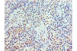 Immunohistochemistry of paraffin-embedded human breast cancer using ABIN7172022 at dilution of 1:100 (TXNRD2 抗体  (AA 100-310))