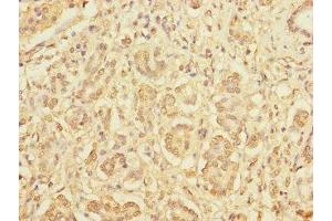 Immunohistochemistry of paraffin-embedded human pancreatic cancer using ABIN7165266 at dilution of 1:100 (DIAPH2 抗体  (AA 1-120))