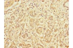 Immunohistochemistry of paraffin-embedded human pancreatic cancer using ABIN7165266 at dilution of 1:100 (DIAPH2 抗体  (AA 1-120))