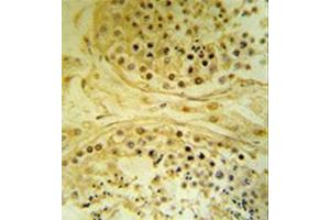 Immunohistochemistry analysis in formalin fixed and paraffin embedded human testis carcinoma reacted with  BXDC4 / IMP4 Antibody (C-term) followed by peroxidase conjugation of the secondary antibody and DAB staining. (IMP4 抗体  (C-Term))