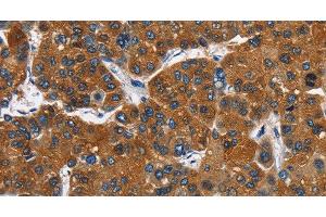 Immunohistochemistry of paraffin-embedded Human liver cancer tissue using CATSPER3 Polyclonal Antibody at dilution 1:60 (CATSPER3 抗体)