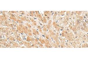 Immunohistochemistry of paraffin-embedded Human liver cancer tissue using TRUB1 Polyclonal Antibody at dilution of 1:85(x200) (TRUB1 抗体)
