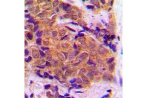 Immunohistochemical analysis of EIF4E staining in human breast cancer formalin fixed paraffin embedded tissue section. (EIF4E 抗体  (C-Term))