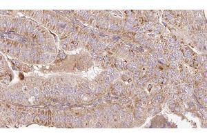 ABIN6267191 at 1/100 staining Human thyroid cancer tissue by IHC-P. (tau 抗体  (pSer199))