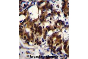 TRADD Antibody immunohistochemistry analysis in formalin fixed and paraffin embedded human breast carcinoma followed by peroxidase conjugation of the secondary antibody and DAB staining. (TRADD 抗体  (AA 126-151))