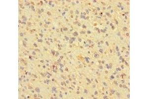 Immunohistochemistry of paraffin-embedded human glioma using ABIN7163790 at dilution of 1:100 (BMI1 抗体  (AA 1-247))