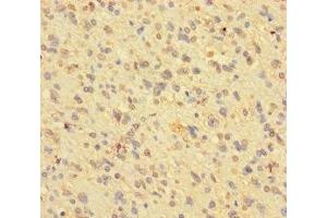 Immunohistochemistry of paraffin-embedded human glioma using ABIN7163790 at dilution of 1:100 (BMI1 抗体  (AA 1-247))