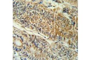 Immunohistochemistry analysis in colon carcinoma (Formalin-fixed, Paraffin-embedded) using PYCR1  Antibody (C-term), followed by peroxidase conjugation of the secondary antibody and DAB staining. (PYCR1 抗体  (C-Term))