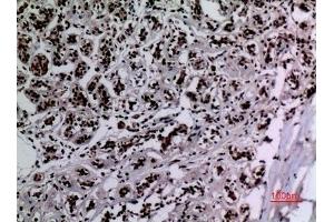Immunohistochemical analysis of paraffin-embedded human-breast, antibody was diluted at 1:100. (HSP90 抗体  (acLys284, acLys292))