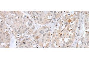 Immunohistochemistry of paraffin-embedded Human esophagus cancer tissue using BORCS8 Polyclonal Antibody at dilution of 1:50(x200) (MEF2BNB 抗体)