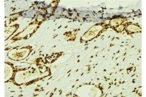 ABIN6274367 at 1/100 staining Human breast cancer tissue by IHC-P.