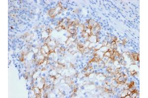 Formalin-fixed, paraffin-embedded human Renal Cell Carcinoma stained with Cadherin 16 Mouse Monoclonal Antibody (CDH16/2448). (Cadherin-16 抗体  (AA 371-507))