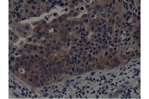 Immunohistochemical staining of paraffin-embedded Carcinoma of Human bladder tissue using anti-SH3GL1 mouse monoclonal antibody. (SH3GL1 抗体)