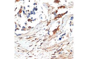 Immunohistochemistry of paraffin-embedded human lung cancer using JNK1/2/3 Rabbit pAb (ABIN7268630) at dilution of 1:100 (40x lens). (MAPK8/9/10 抗体)