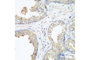 Immunohistochemistry of paraffin-embedded human prostate using CBL antibody (ABIN6131302, ABIN6138002, ABIN6138004 and ABIN6213970) at dilution of 1:200 (40x lens). (CBL 抗体  (AA 637-906))