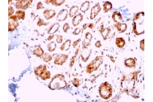 Formalin-fixed, paraffin-embedded human Breast Carcinoma stained with ERCC1 Mouse Monoclonal Antibody (ERCC1/2318). (ERCC1 抗体  (AA 191-281))