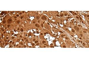 Immunohistochemistry of paraffin-embedded Human esophagus cancer tissue using LAMTOR5 Polyclonal Antibody at dilution of 1:35(x200) (HBXIP 抗体)