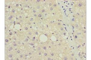 Immunohistochemistry of paraffin-embedded human liver cancer using ABIN7150132 at dilution of 1:100 (DDIT3 抗体  (AA 1-169))