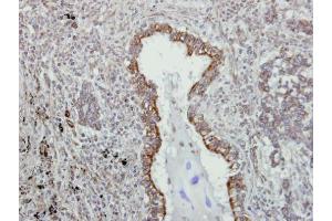 IHC-P Image Immunohistochemical analysis of paraffin-embedded human lung adenocarcinoma, using VAPA, antibody at 1:500 dilution. (VAPA 抗体)
