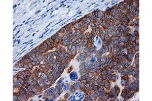 Immunohistochemical staining of paraffin-embedded Adenocarcinoma of breast tissue using anti-RALBP1 mouse monoclonal antibody. (RALBP1 抗体)