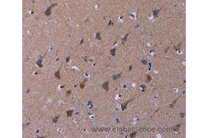 Immunohistochemistry of Human thyroid cancer using TUBGCP2 Polyclonal Antibody at dilution of 1:50 (TUBGCP2 抗体)