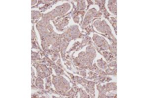 Immunohistochemical analysis of B on paraffin-embedded Human breast carcinoma tissue. (RPL23A 抗体  (C-Term))
