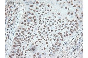 Immunohistochemical staining of paraffin-embedded Adenocarcinoma of colon using anti-Nog (ABIN2452676) mouse monoclonal antibody. (NOG 抗体  (AA 28-232))