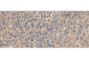 Immunohistochemistry of paraffin-embedded Human cervical cancer tissue using AHNAK Polyclonal Antibody at dilution of 1:50(x200) (AHNAK 抗体)