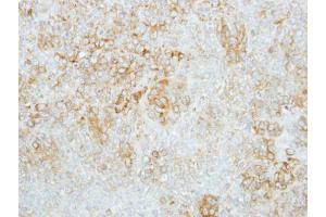 IHC-P Image Immunohistochemical analysis of paraffin-embedded human lung cancer, using GBA, antibody at 1:100 dilution. (GBA 抗体  (C-Term))