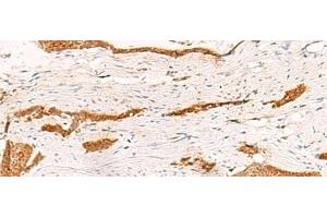 Immunohistochemistry of paraffin-embedded Human esophagus cancer tissue using THNSL1 Polyclonal Antibody at dilution of 1:70(x200) (THNSL1 抗体)
