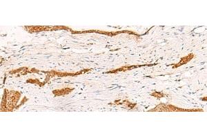 Immunohistochemistry of paraffin-embedded Human esophagus cancer tissue using THNSL1 Polyclonal Antibody at dilution of 1:70(x200) (THNSL1 抗体)