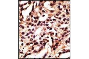 Formalin-fixed and paraffin-embedded human cancer tissue reacted with Autophagy APG12L Antibody (N-term), which was peroxidase-conjugated to the secondary antibody, followed by DAB staining. (ATG12 抗体  (N-Term))