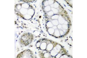Immunohistochemistry of paraffin-embedded human colon carcinoma using CDC27 antibody at dilution of 1:200 (40x lens). (CDC27 抗体)